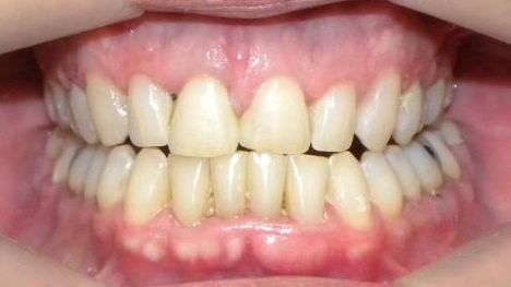 Frontal (Oclusión)