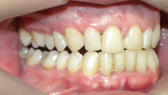 Lateral Derecha