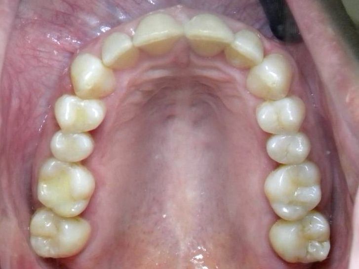 Oclusal Superior
