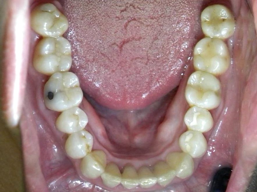 Oclusal Inferior