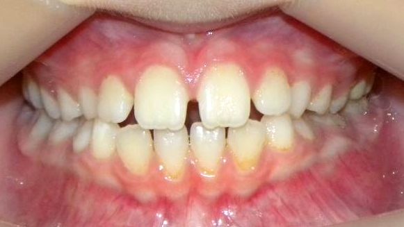 Frontal (Oclusión)