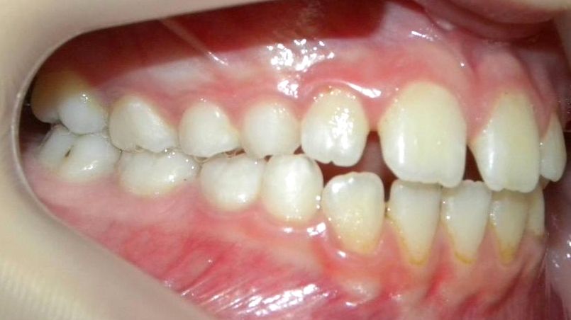 Lateral Derecha