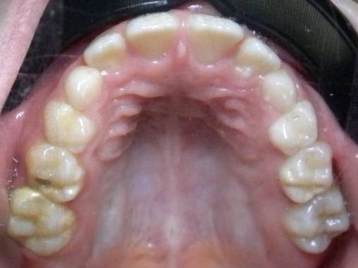 Oclusal Superior