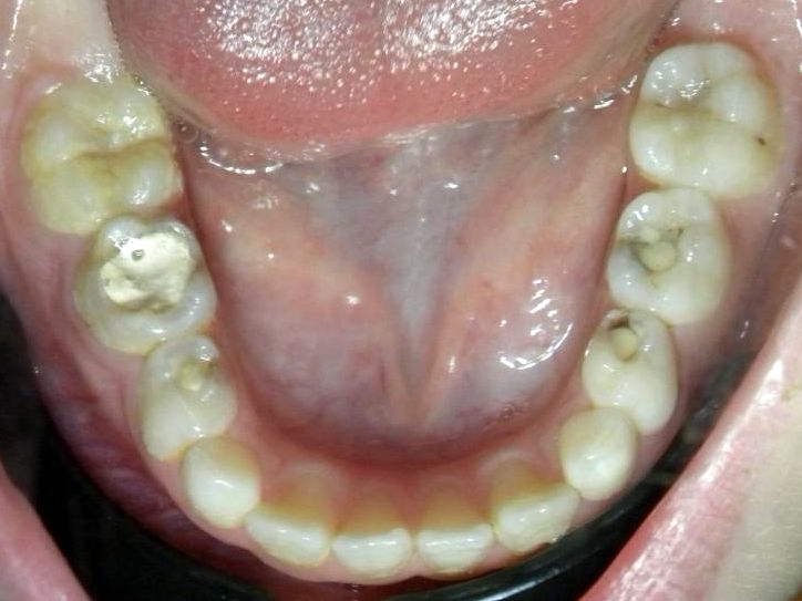 Oclusal Inferior