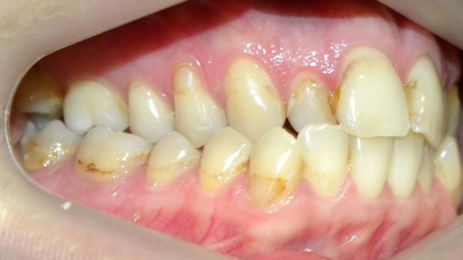 Lateral Derecha