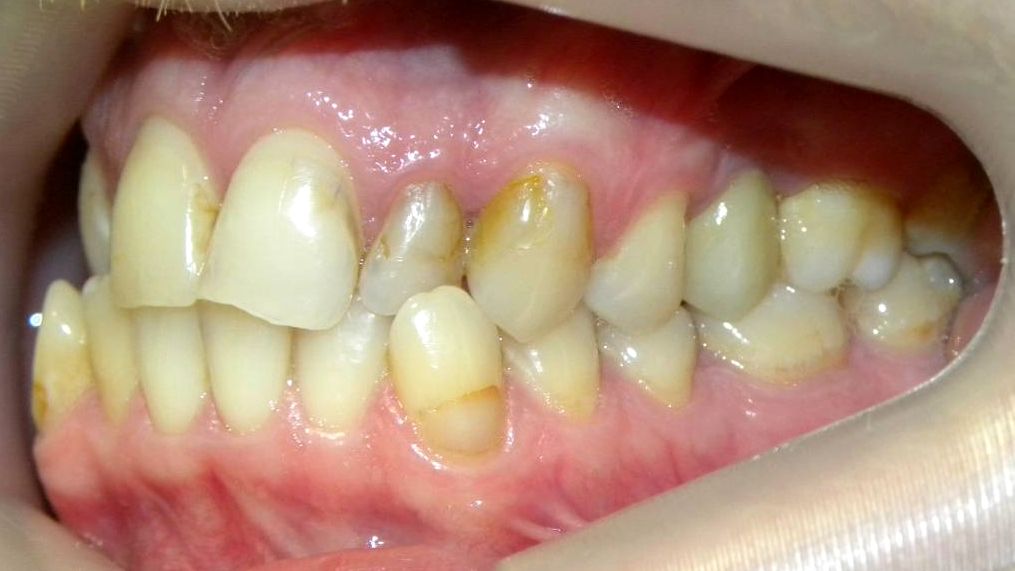 Lateral Izquierda