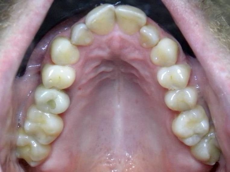 Oclusal Superior