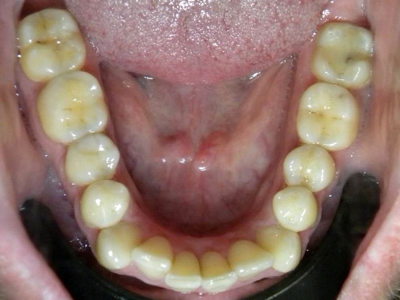 Oclusal Inferior