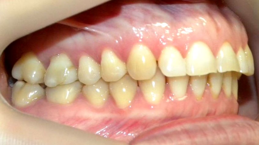 Lateral Derecha