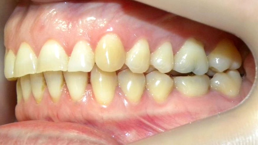 Lateral Izquierda