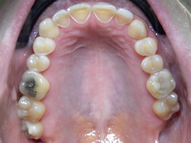 Oclusal Superior