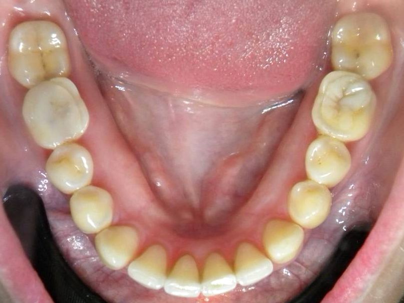 Oclusal Inferior