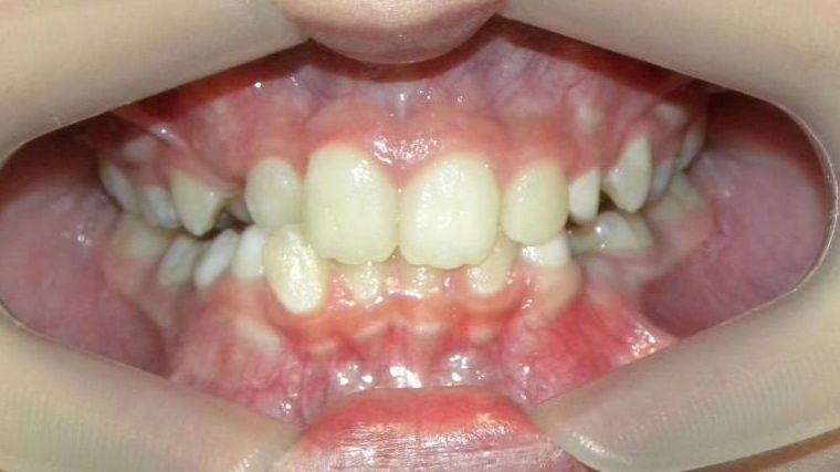 Frontal (Oclusión)