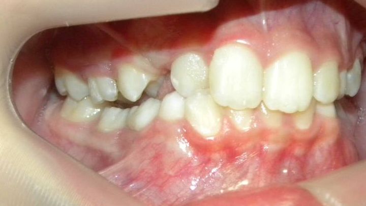 Lateral Derecha