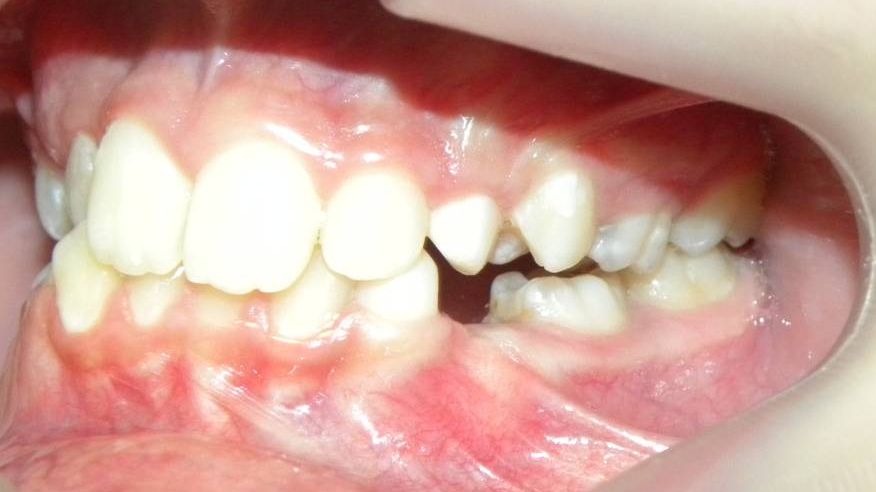 Lateral Izquierda
