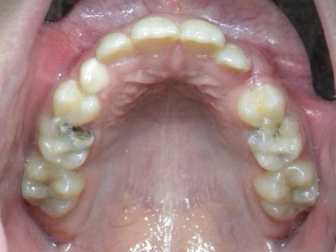 Oclusal Superior