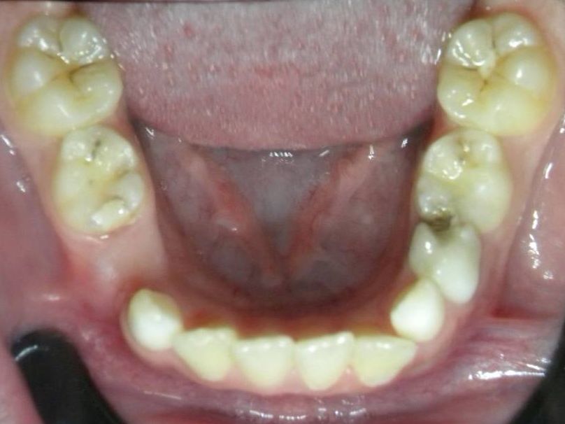 Oclusal Inferior