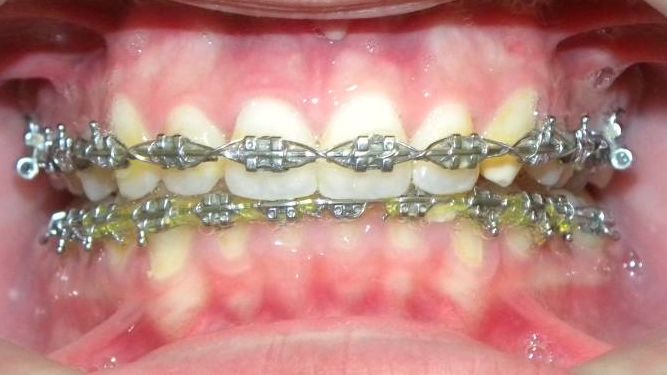 Frontal (Oclusión)