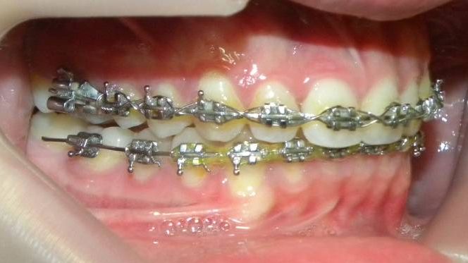 Lateral Derecha