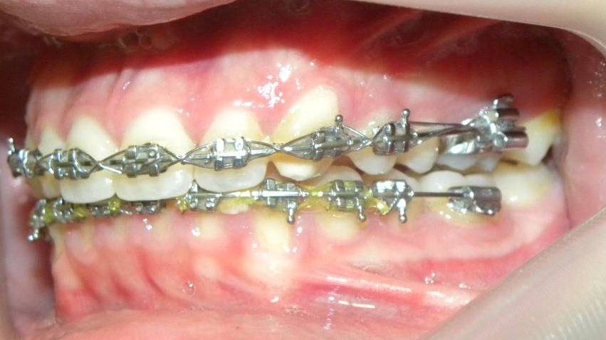 Lateral Izquierda