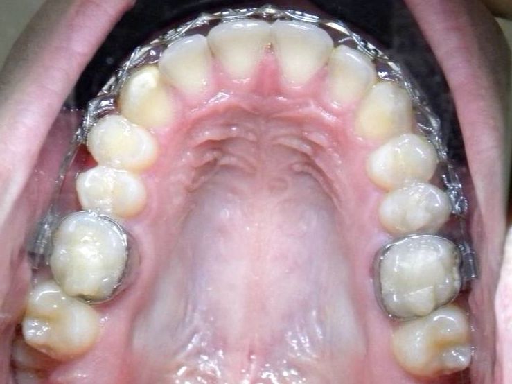Oclusal Superior