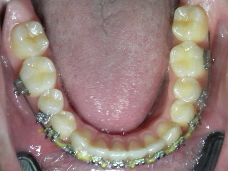 Oclusal Inferior