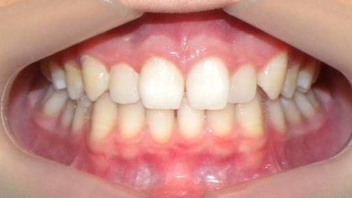 Frontal (Oclusión)