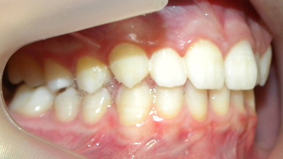 Lateral Derecha