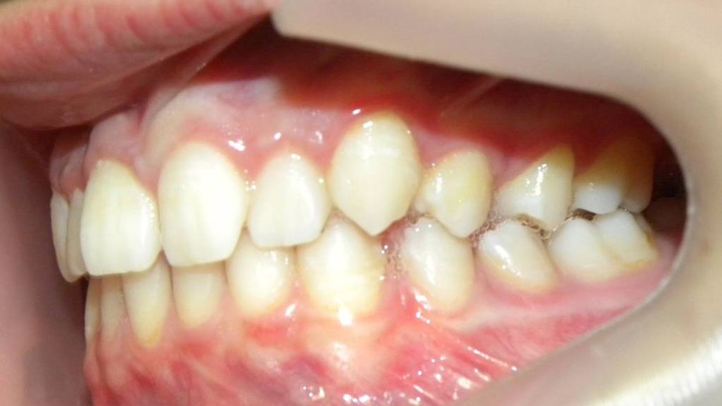 Lateral Izquierda