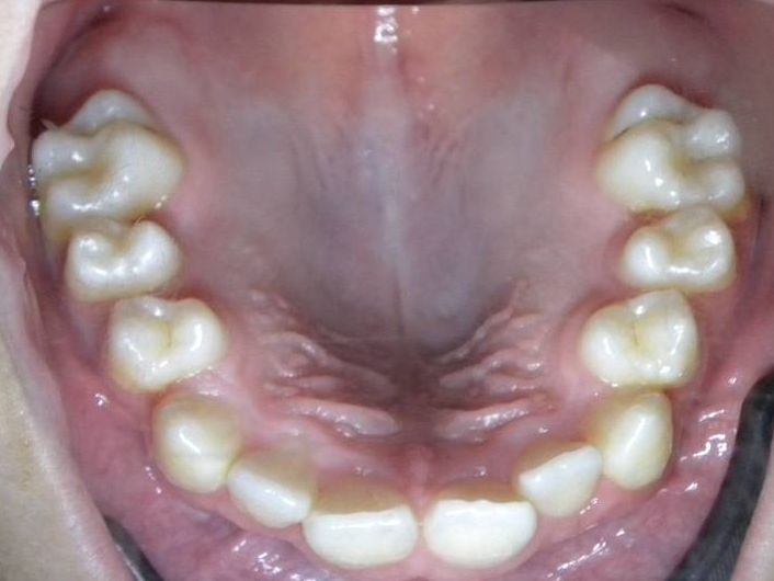 Oclusal Superior