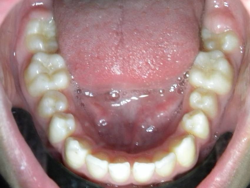 Oclusal Inferior