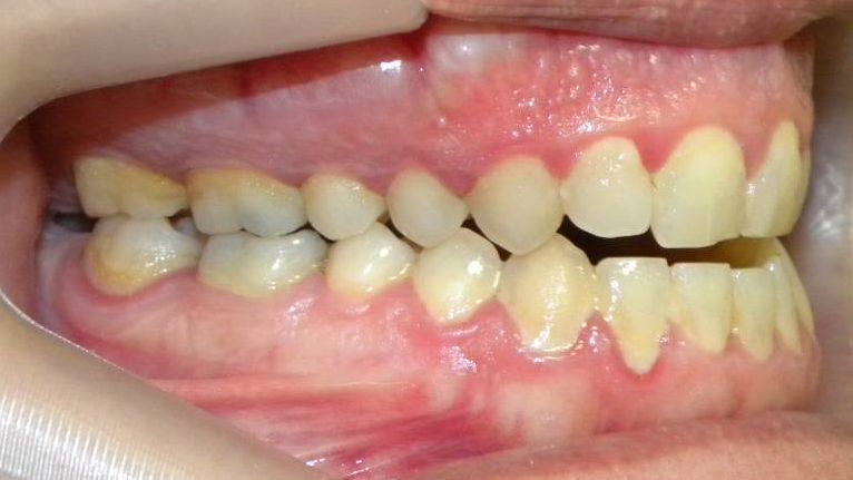 Lateral Derecha