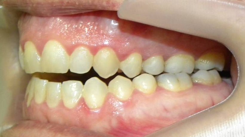 Lateral Izquierda