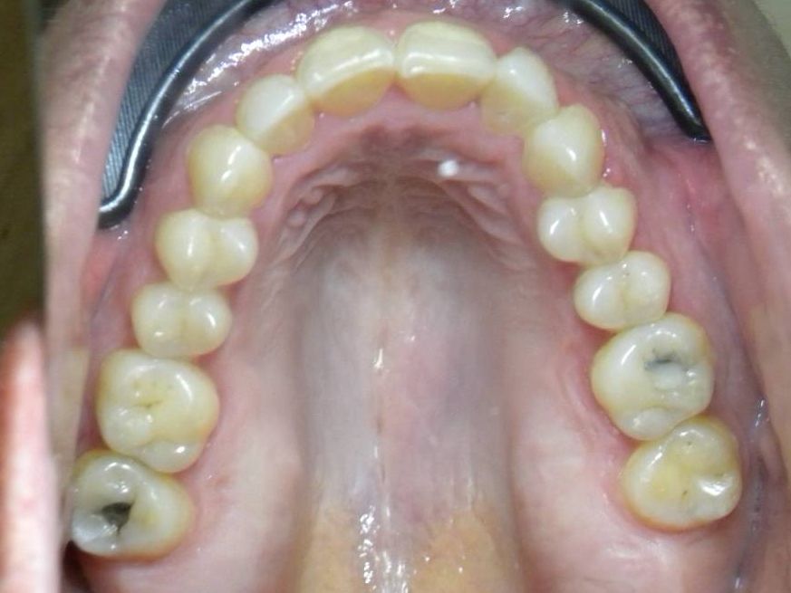 Oclusal Superior
