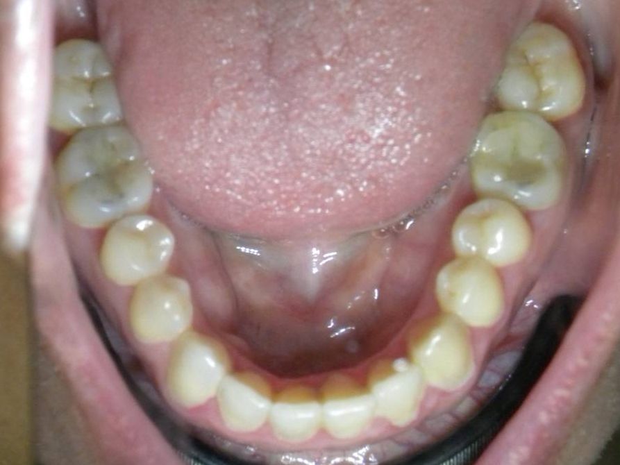 Oclusal Inferior