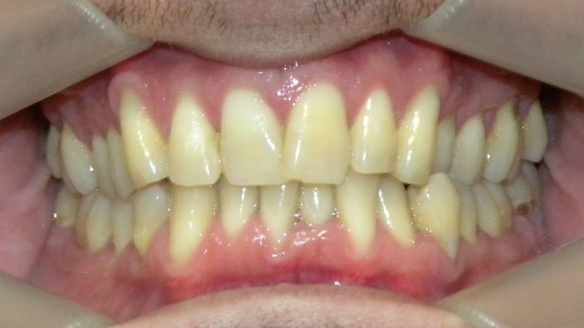 Frontal (Oclusión)
