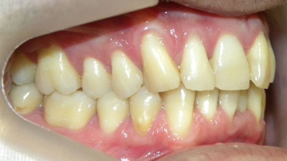 Lateral Derecha