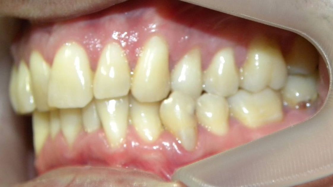Lateral Izquierda