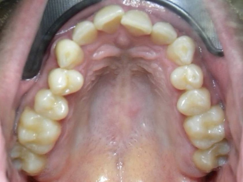 Oclusal Superior
