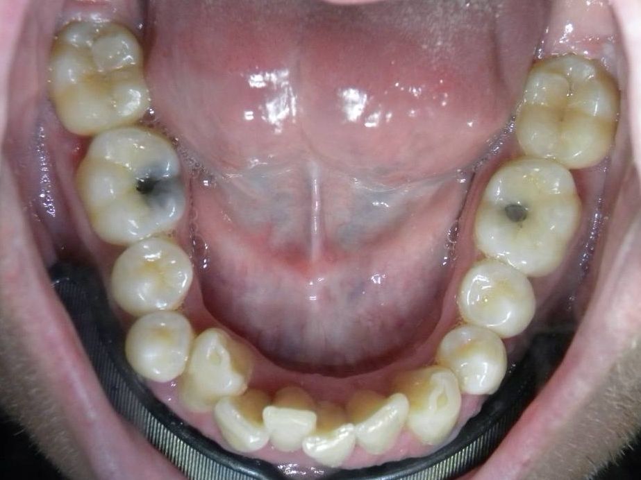 Oclusal Inferior