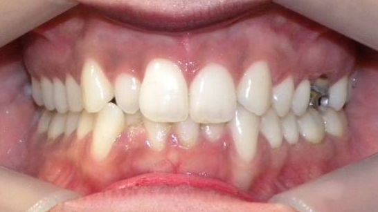 Frontal (Oclusión)