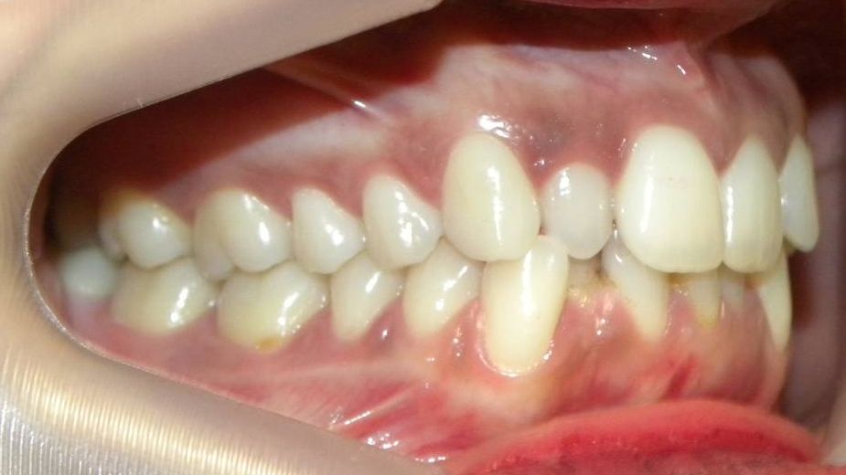 Lateral Derecha