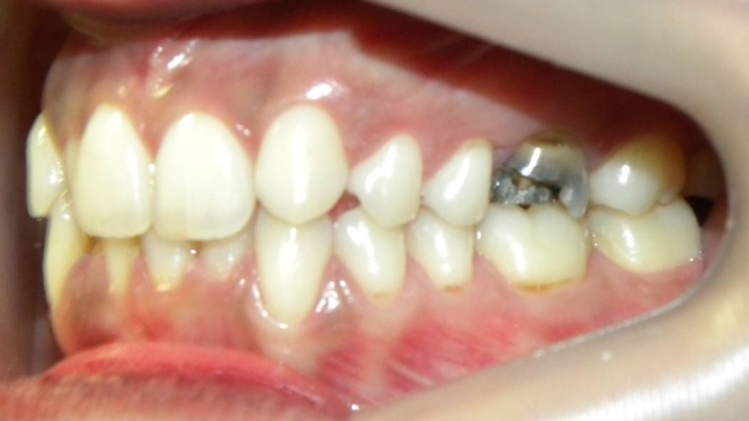 Lateral Izquierda