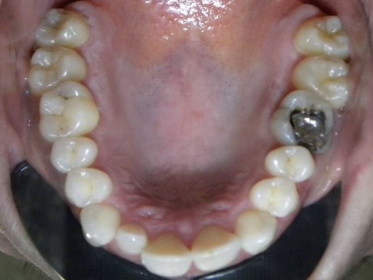 Oclusal Superior