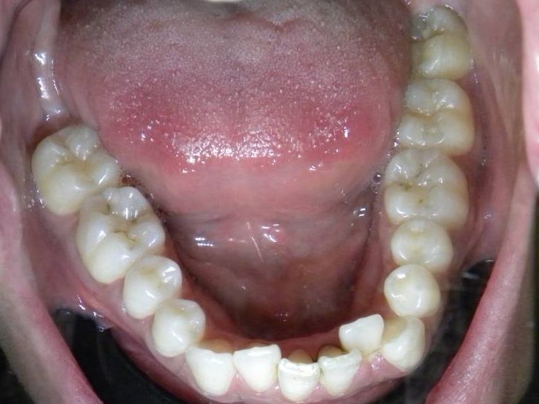 Oclusal Inferior