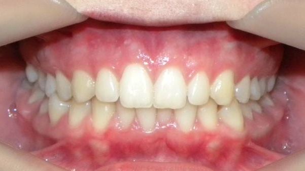 Frontal (Oclusión)