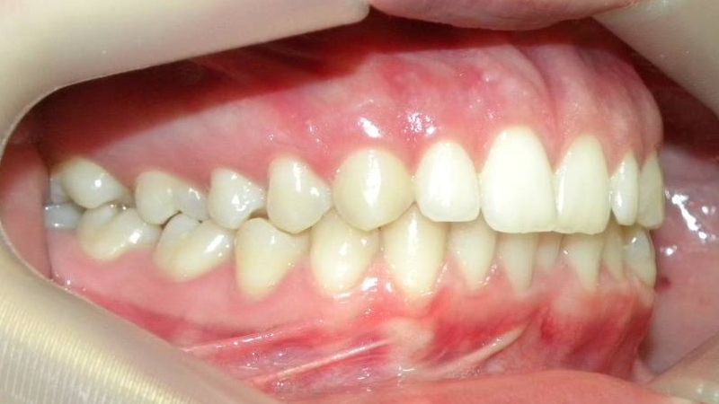 Lateral Derecha