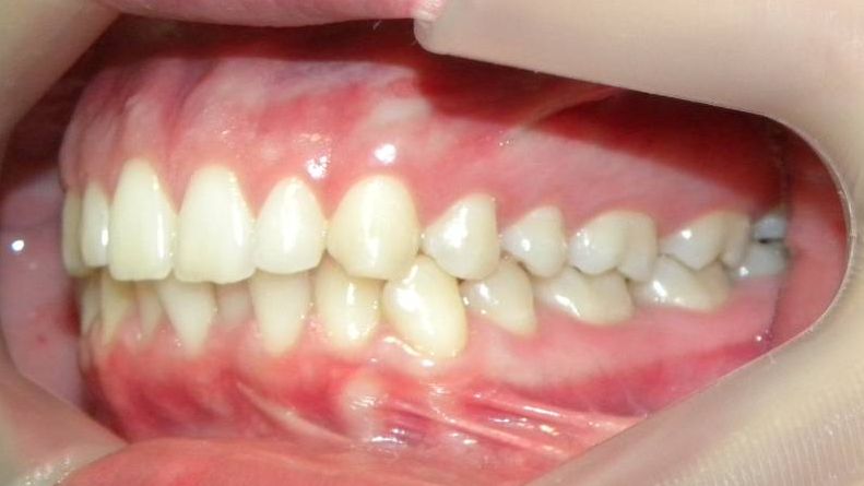 Lateral Izquierda