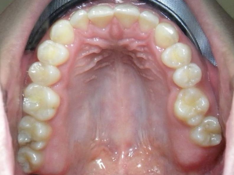 Oclusal Superior