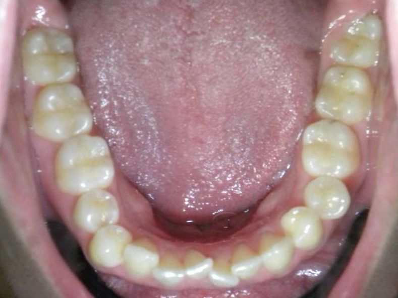 Oclusal Inferior